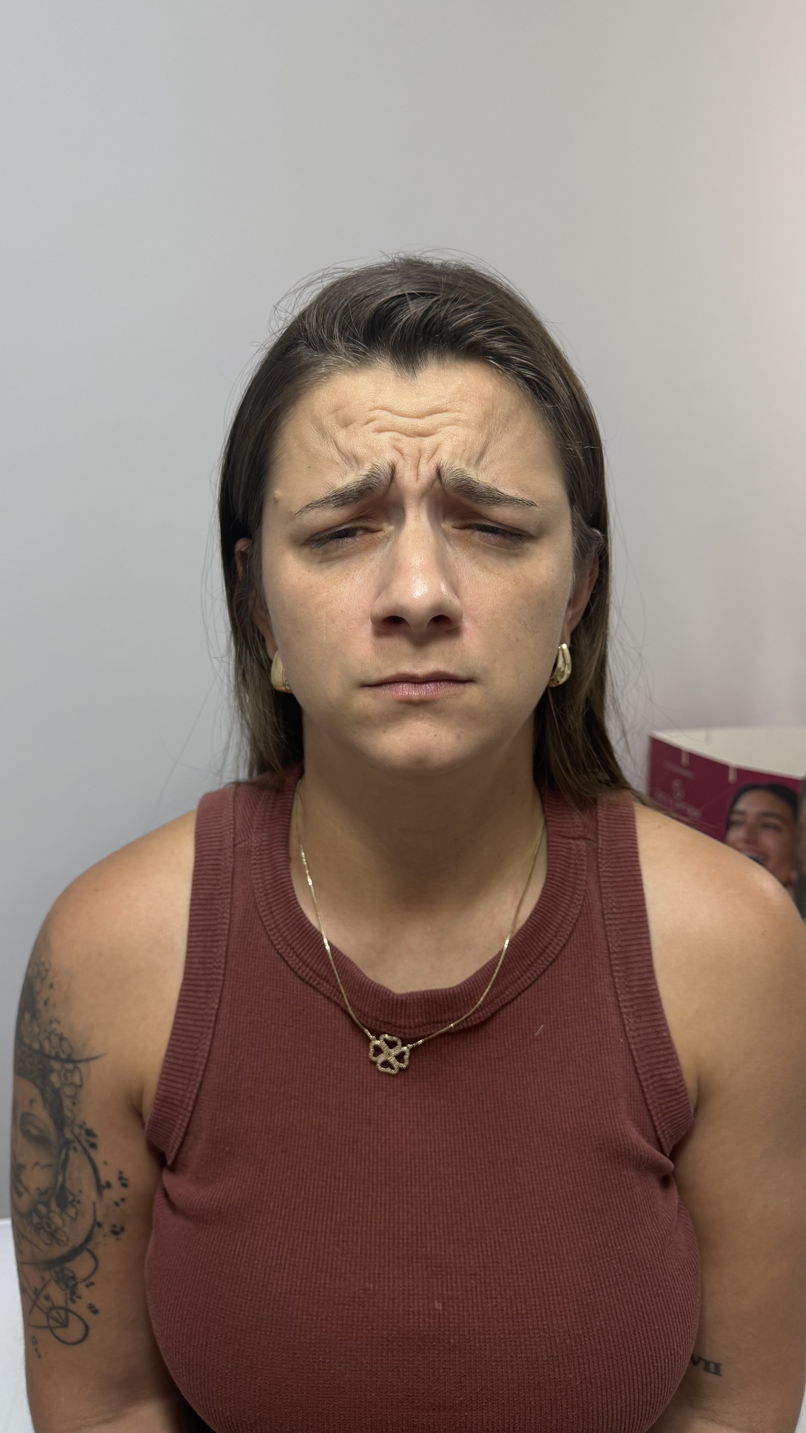 Antes - Toxina Botulínica