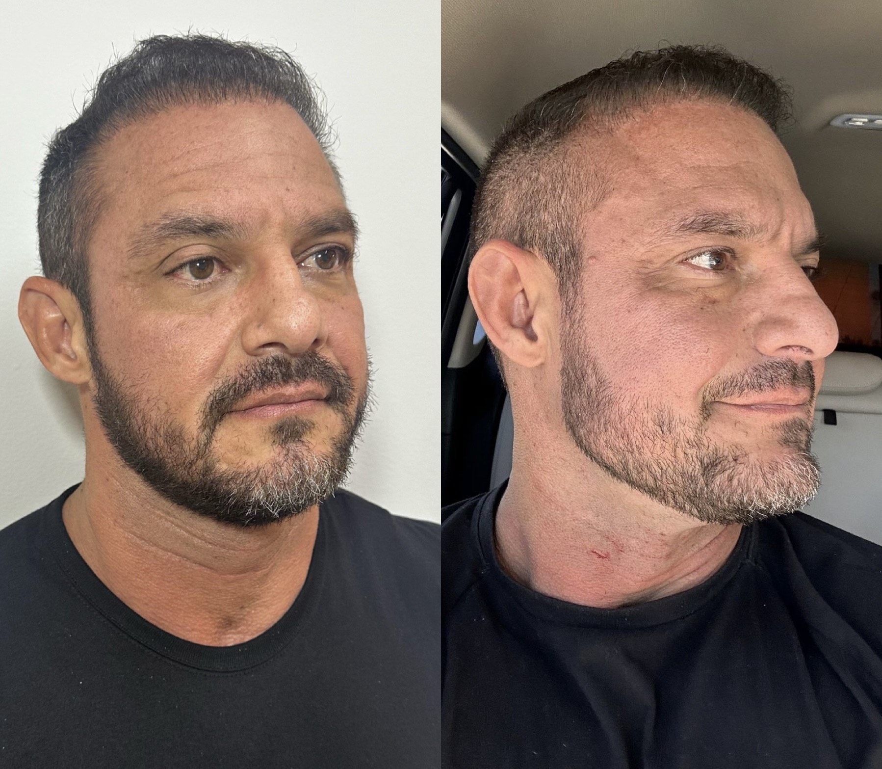 Resultado de Contorno facial