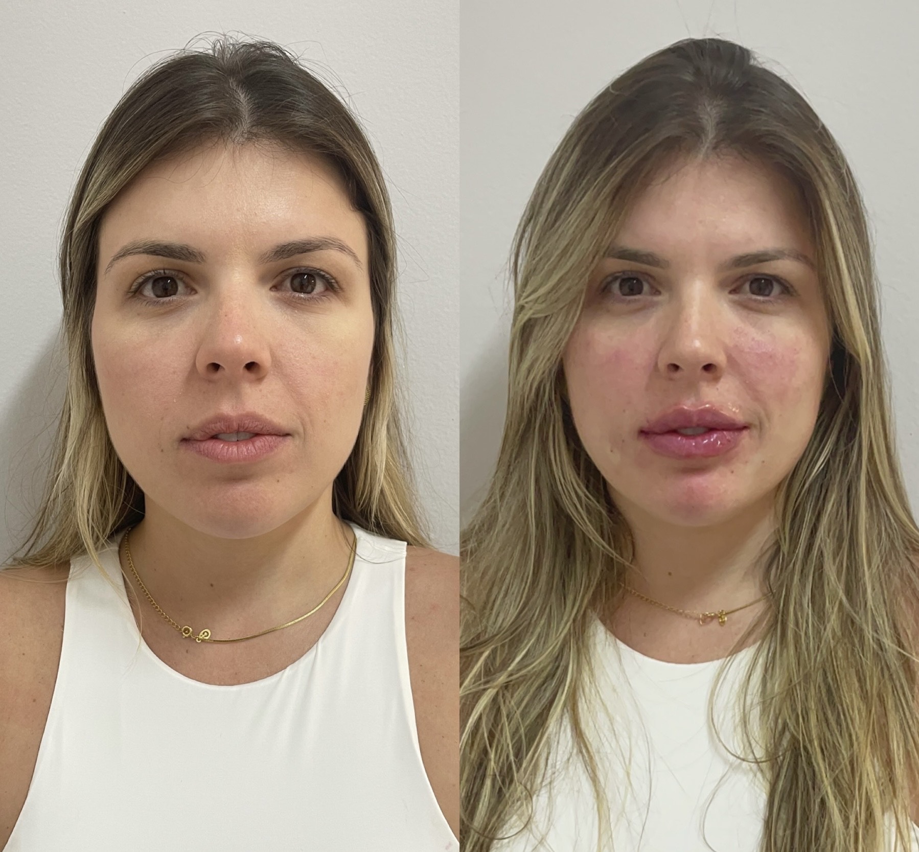 Resultado de Preenchimento FULL face