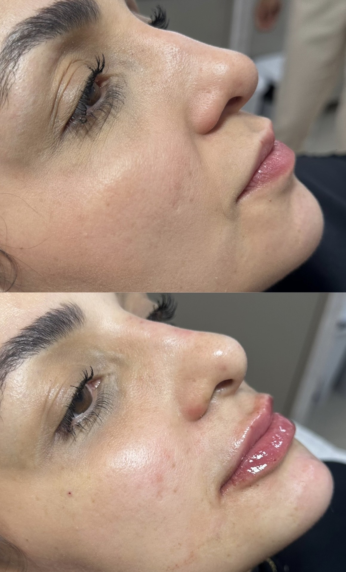 Resultado de Perfiloplastia