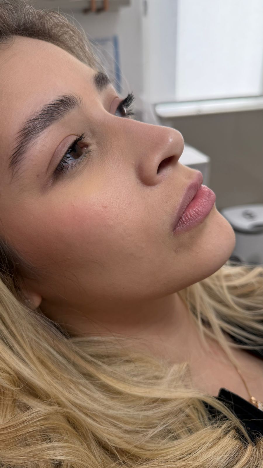 Antes - Rinomodelação